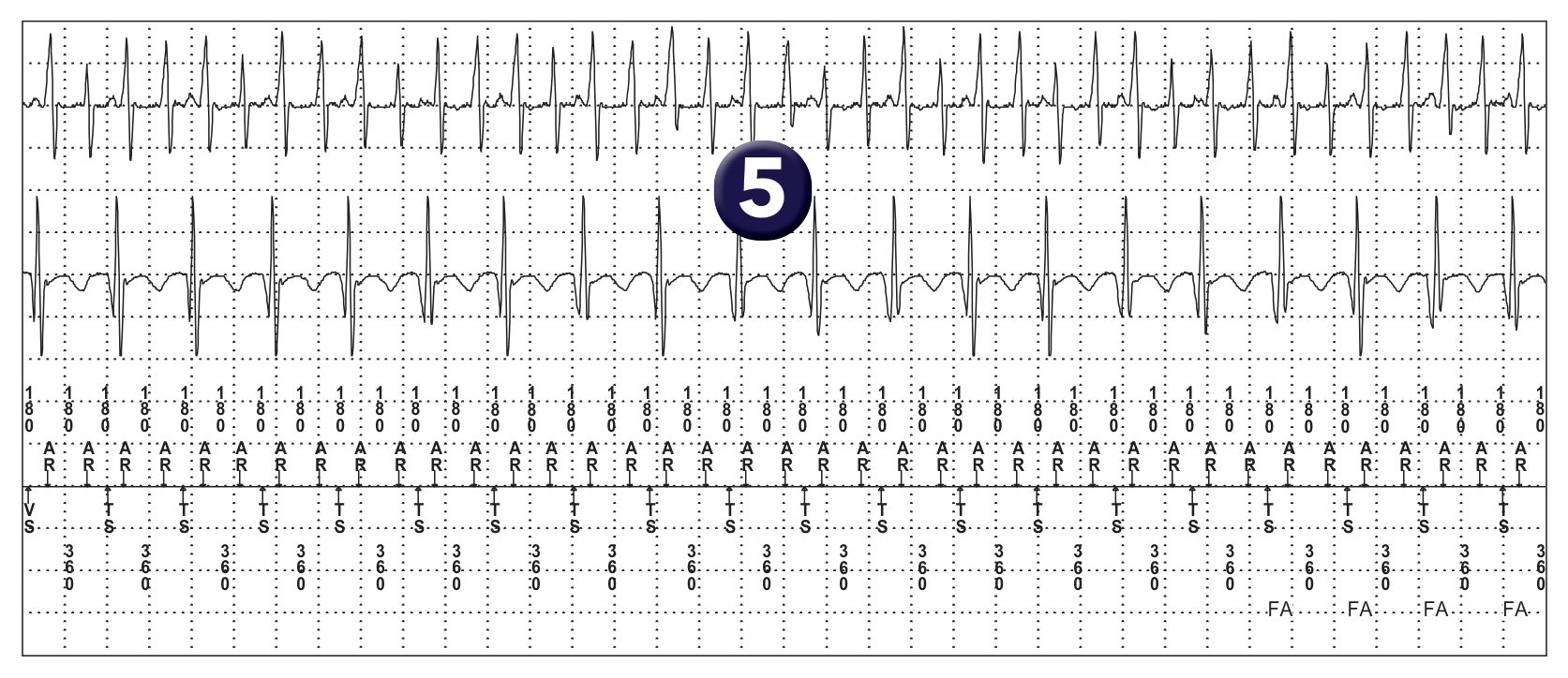 Électrogramme Medtronic DAI, segment 1 sur 1 — PR Logic et flutter atrial