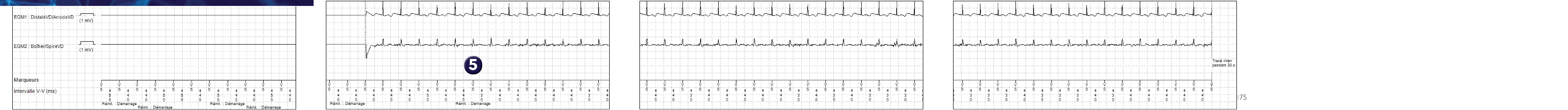 Électrogramme Medtronic DAI, segment 1 sur 2 — Démarrage brutal et tachycardie sinusale