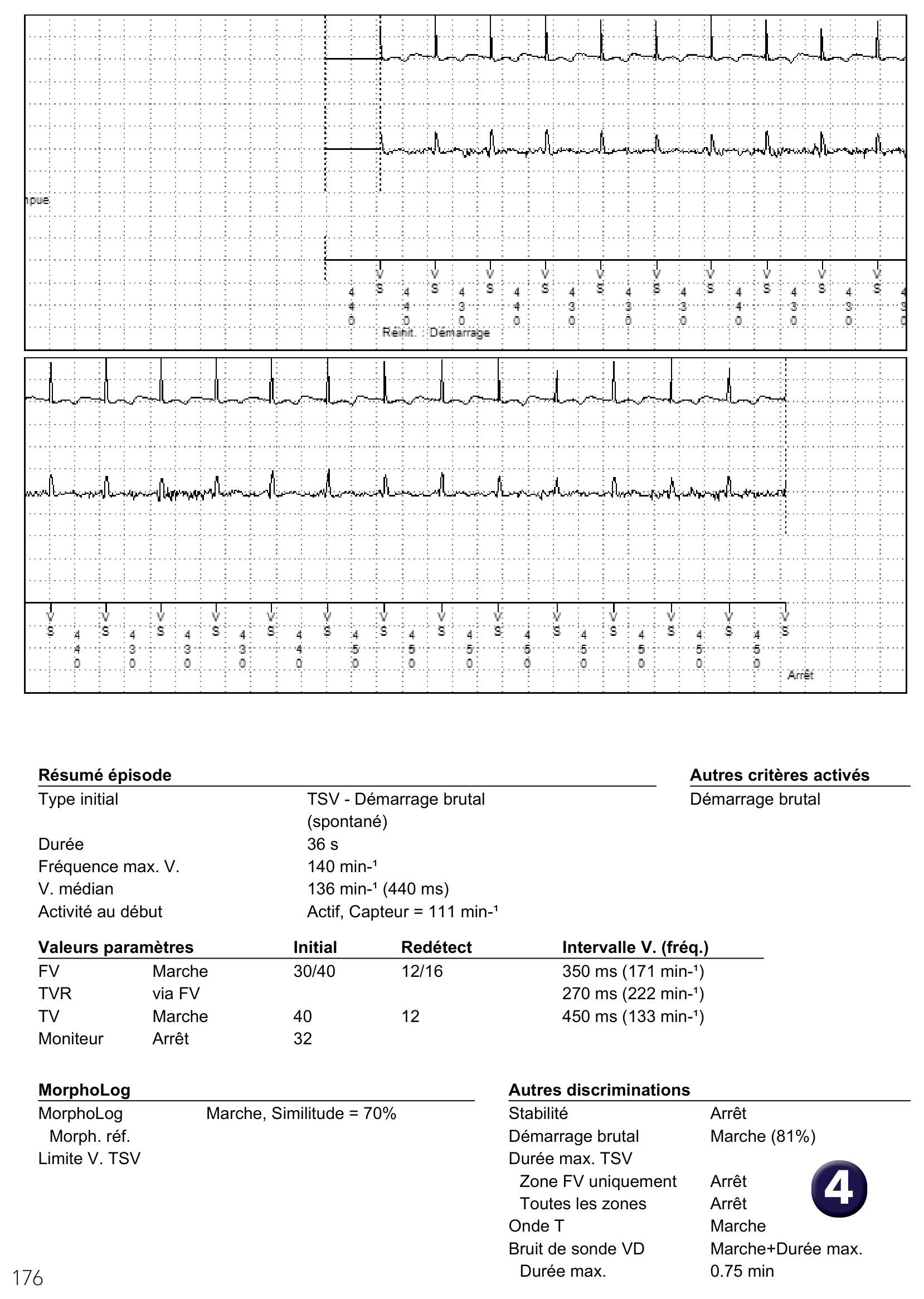 Électrogramme Medtronic DAI, segment 1 sur 1 — Démarrage brutal et tachycardie sinusale