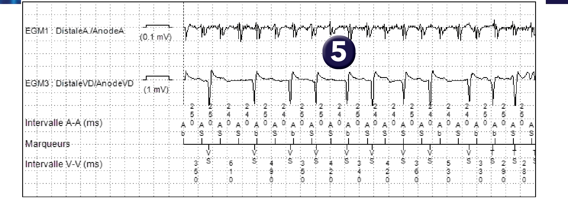 Électrogramme Medtronic DAI, segment 2 sur 3 — Discrimination double chambre et bi-tachycardie