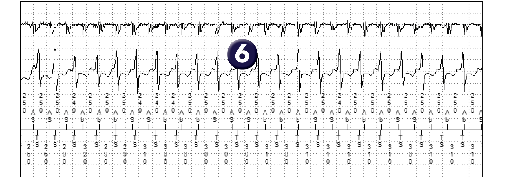 Électrogramme Medtronic DAI, segment 3 sur 3 — Discrimination double chambre et bi-tachycardie