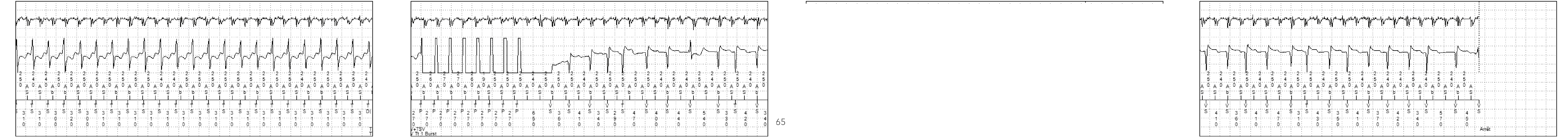 Électrogramme Medtronic DAI, segment 1 sur 1 — Discrimination double chambre et bi-tachycardie