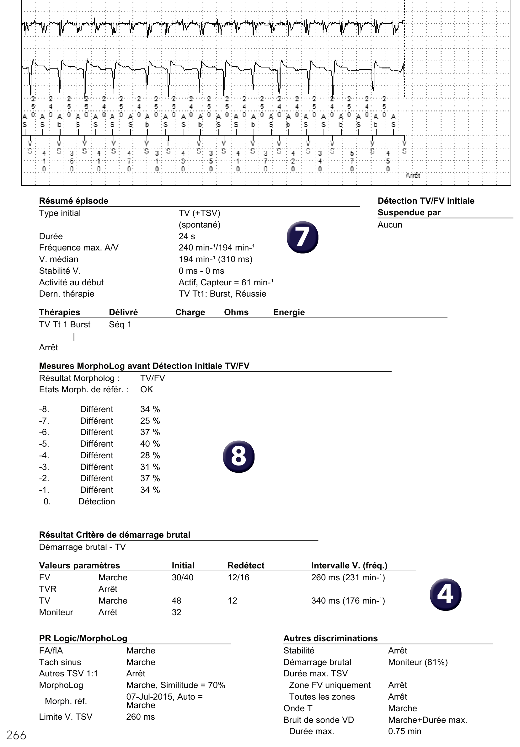 Électrogramme Medtronic DAI, segment 2 sur 2 — Discrimination double chambre et bi-tachycardie