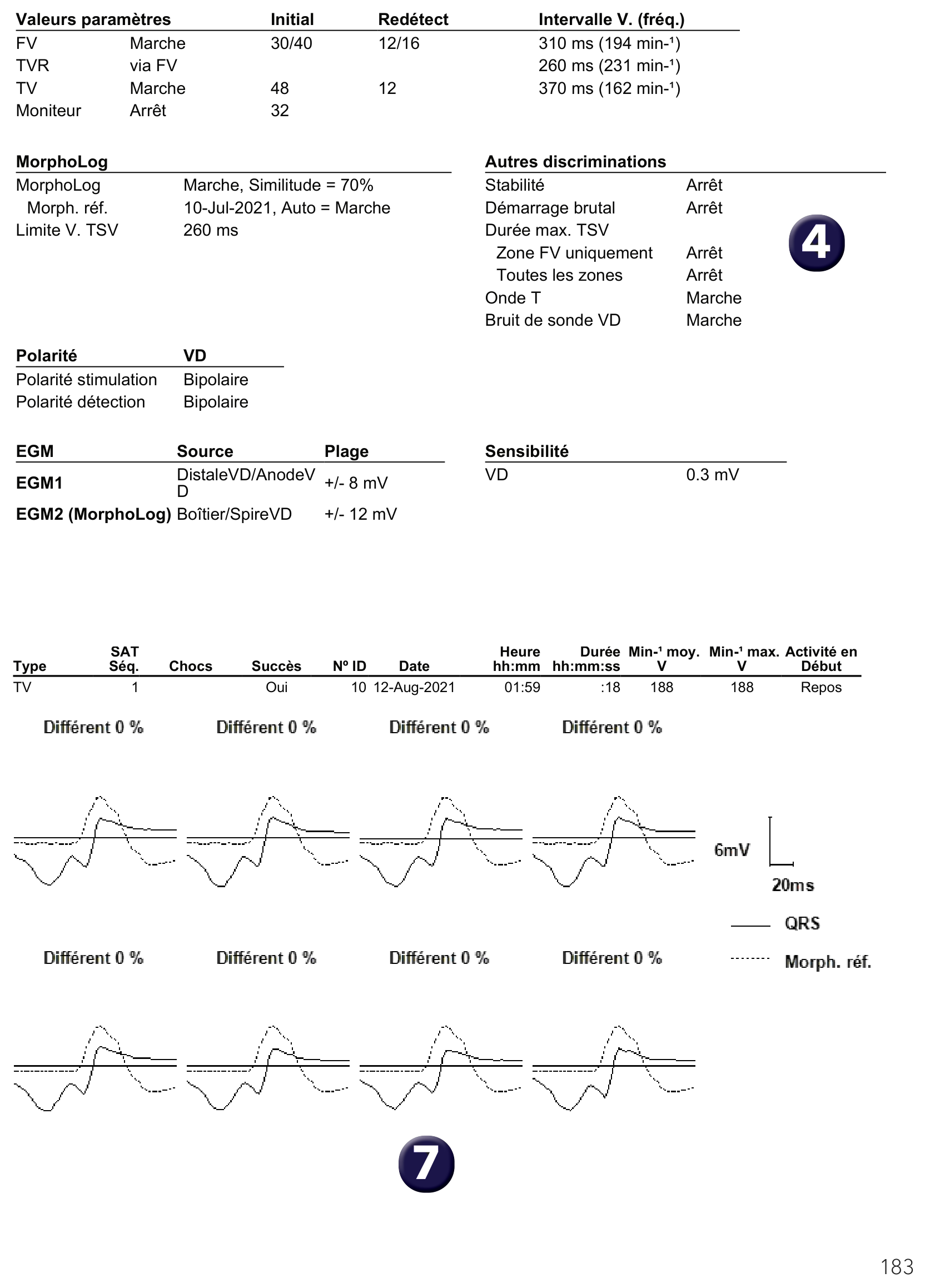 Électrogramme Medtronic DAI, segment 2 sur 2 — Choix des critères de discrimination dans un défibrillateur simple chambre