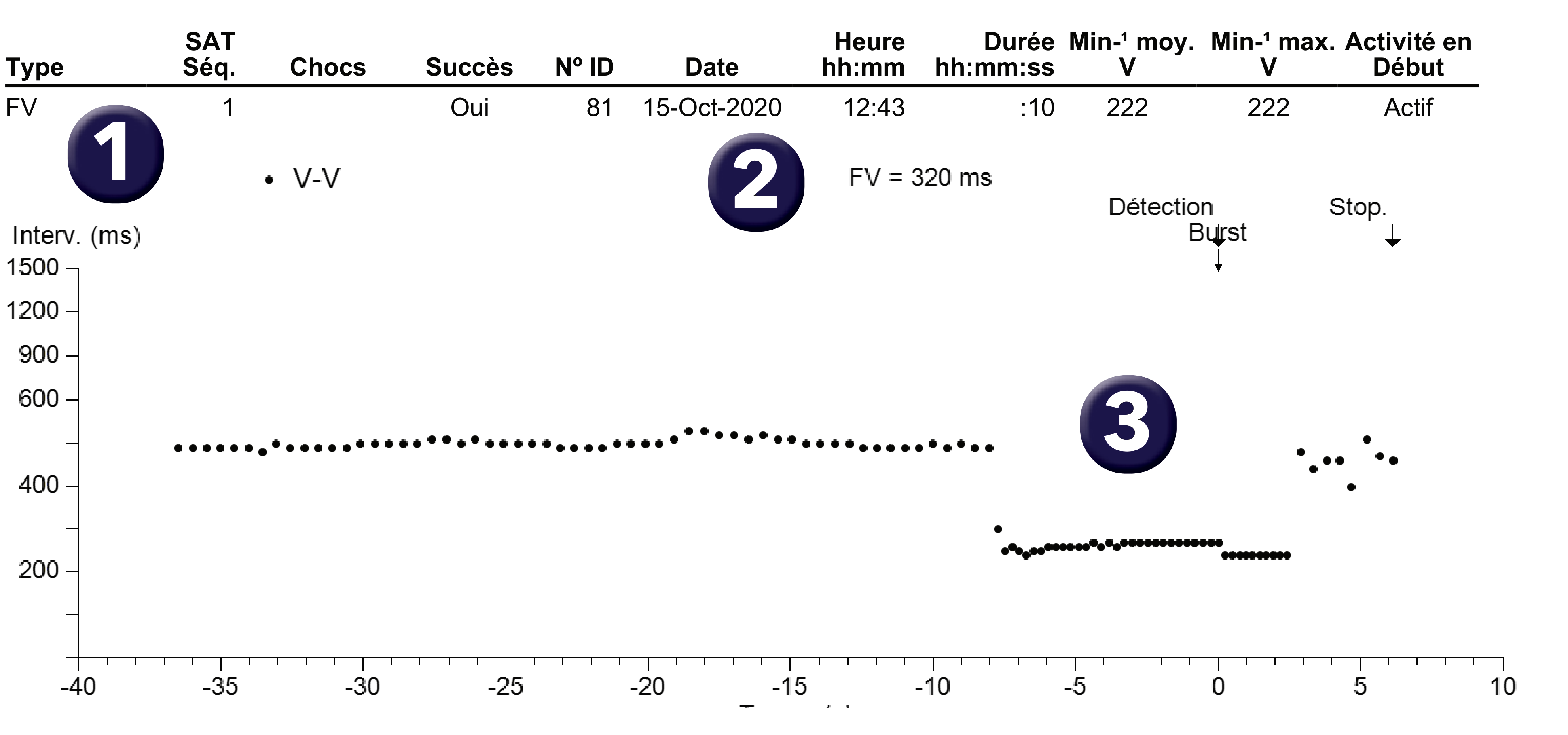 Électrogramme Medtronic DAI, segment 1 sur 1 — Défibrillateur simple chambre et nouvelles recommandations