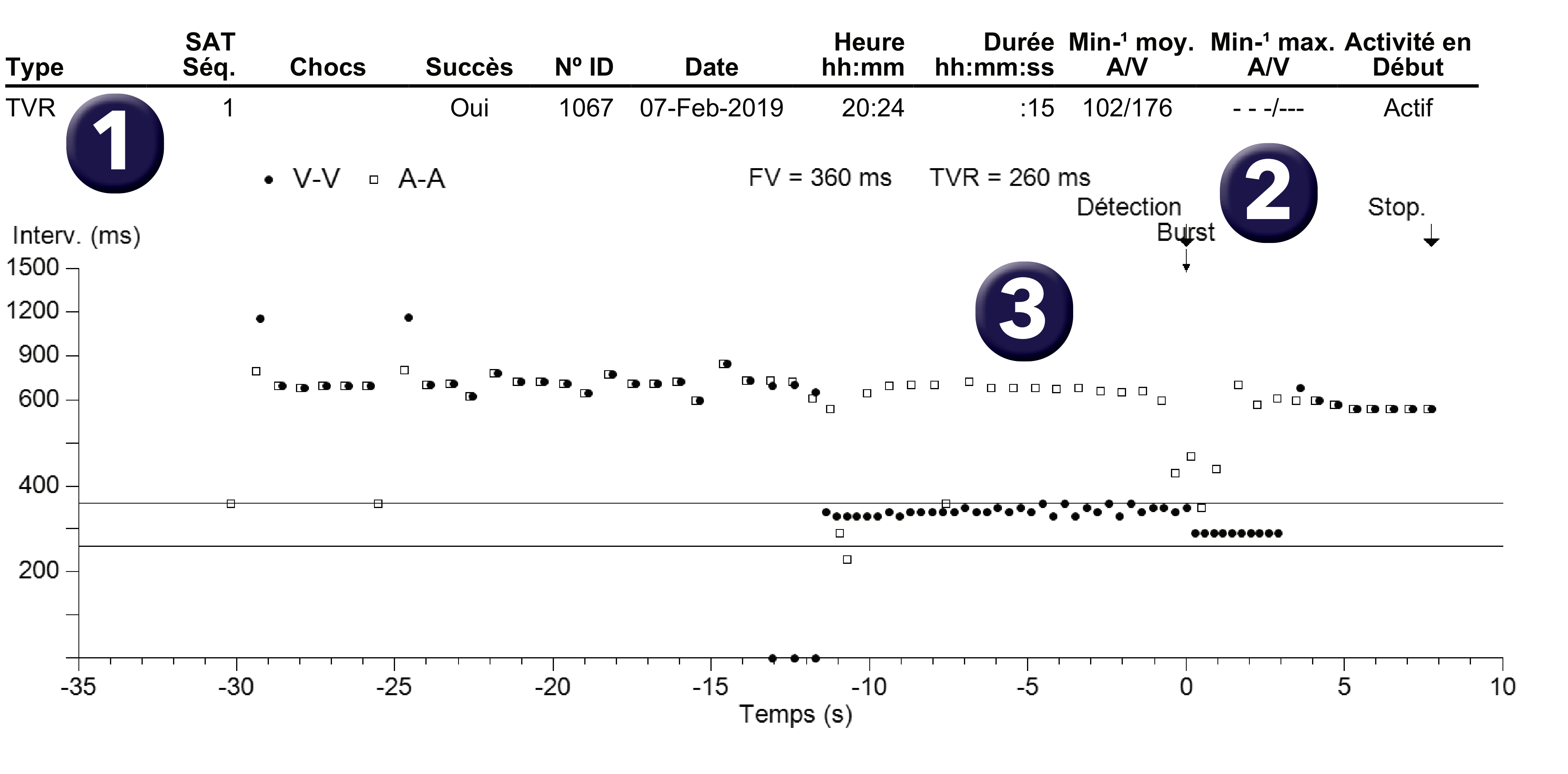 Électrogramme Medtronic DAI, segment 1 sur 1 — Discrimination et troubles de la conduction auriculo-ventriculaire