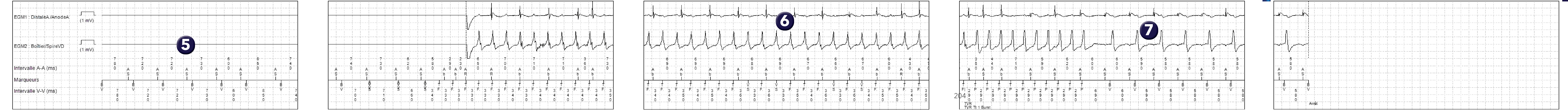 Électrogramme Medtronic DAI, segment 1 sur 1 — Discrimination et troubles de la conduction auriculo-ventriculaire
