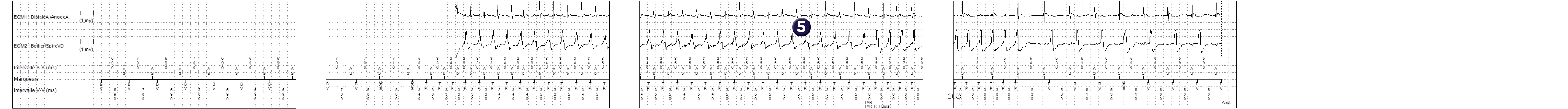 Électrogramme Medtronic DAI, segment 1 sur 1 — Discrimination et troubles de la conduction