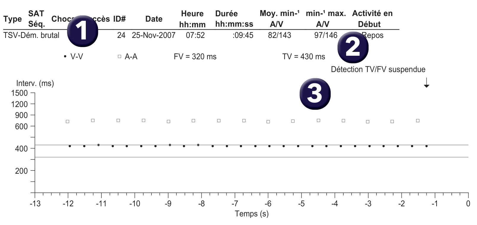 Électrogramme Medtronic DAI, segment 1 sur 1 — Discriminant simple chambre sur un défibrillateur double chambre