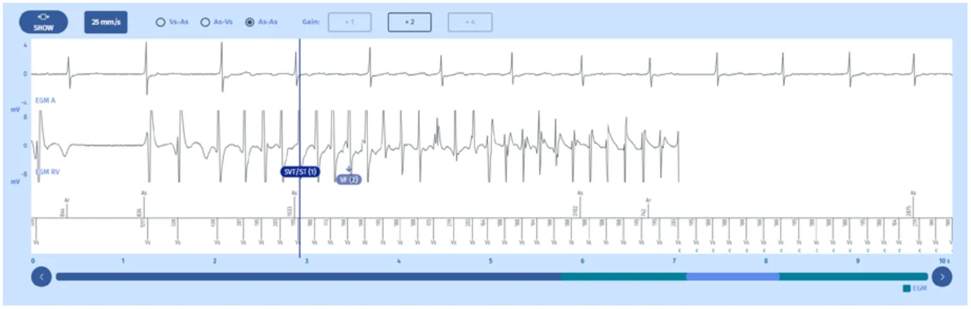 MicroPort DAI, Electrogramme : début — Compteur et diagnostic de la FV