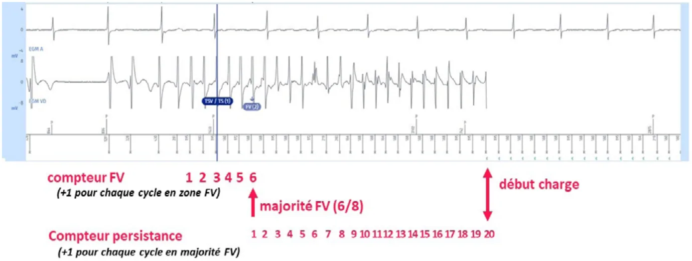 MicroPort DAI, Electrogramme : début — Compteur et diagnostic de la FV