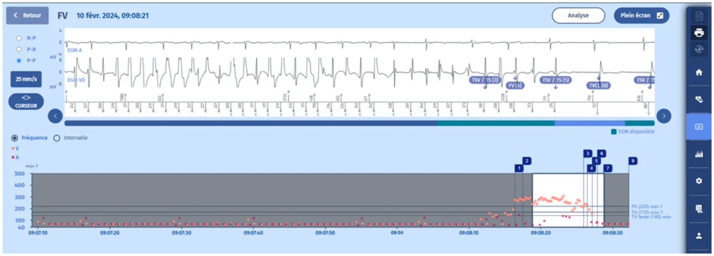 MicroPort DAI, Electrogramme — Tachycardie traitée par un choc, ou est-ce le cas ?
