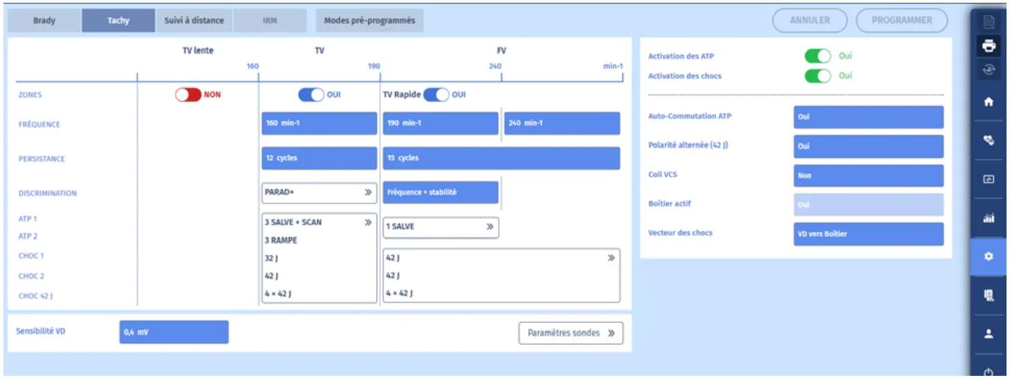 MicroPort DAI, Vous interrogez l’appareil — Tachycardie traitée par une SAT de type burst