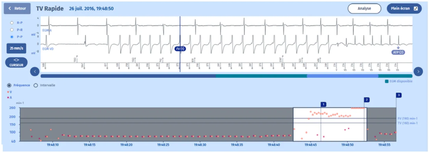 MicroPort DAI, Tachogramme — Tachycardie traitée par une SAT de type burst