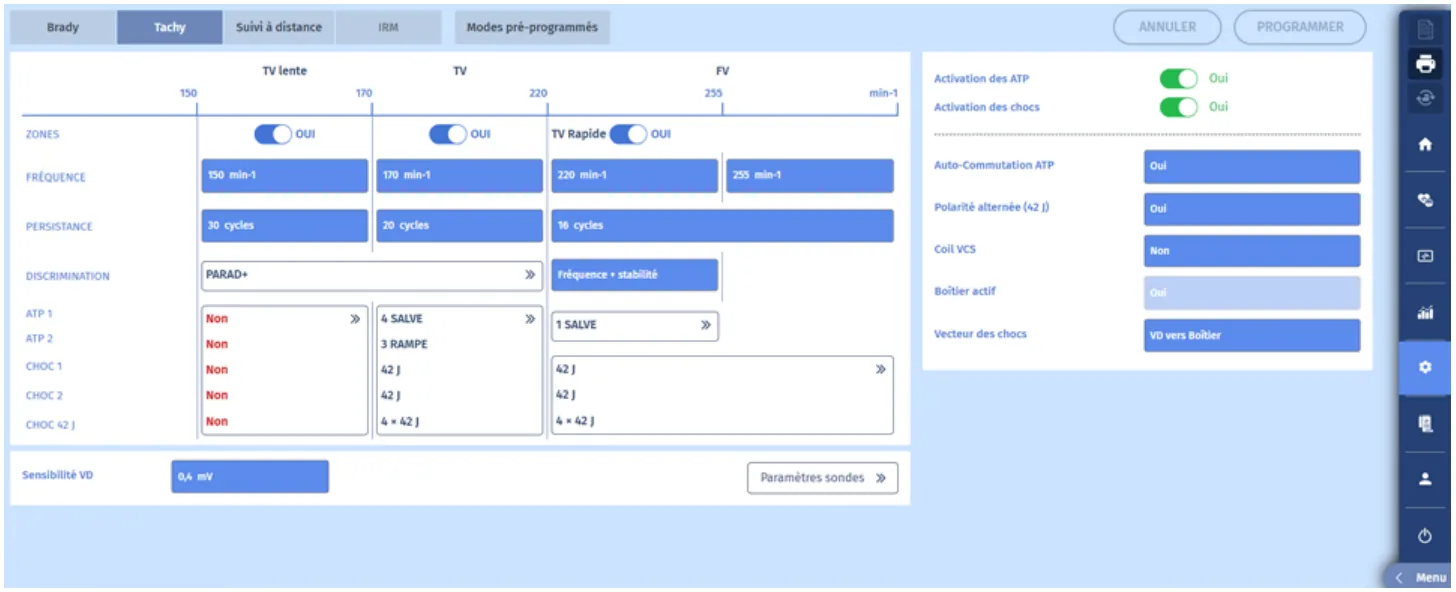 MicroPort DAI, Programmation — Tachycardie traitée par une salve de SAT