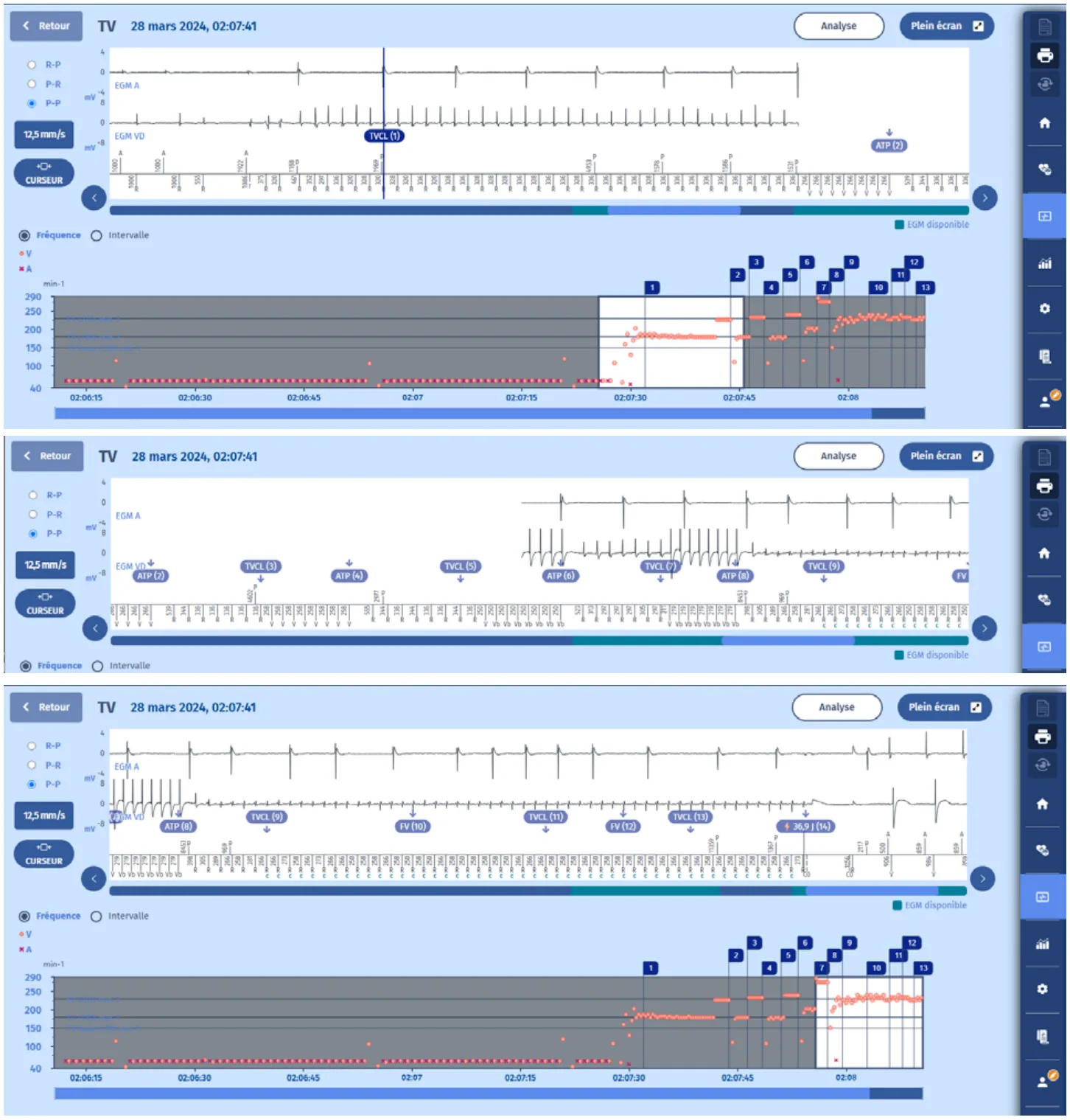 MicroPort DAI, EGM — Effet délétère possible de la stimulation antitachycardique