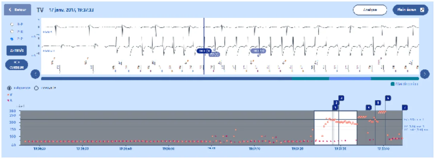 MicroPort DAI, EGM — Tachycardie et zones
