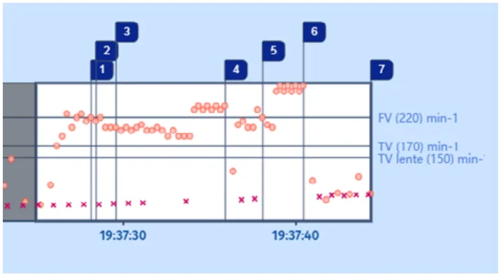 MicroPort DAI, Tachogramme — Tachycardie et zones