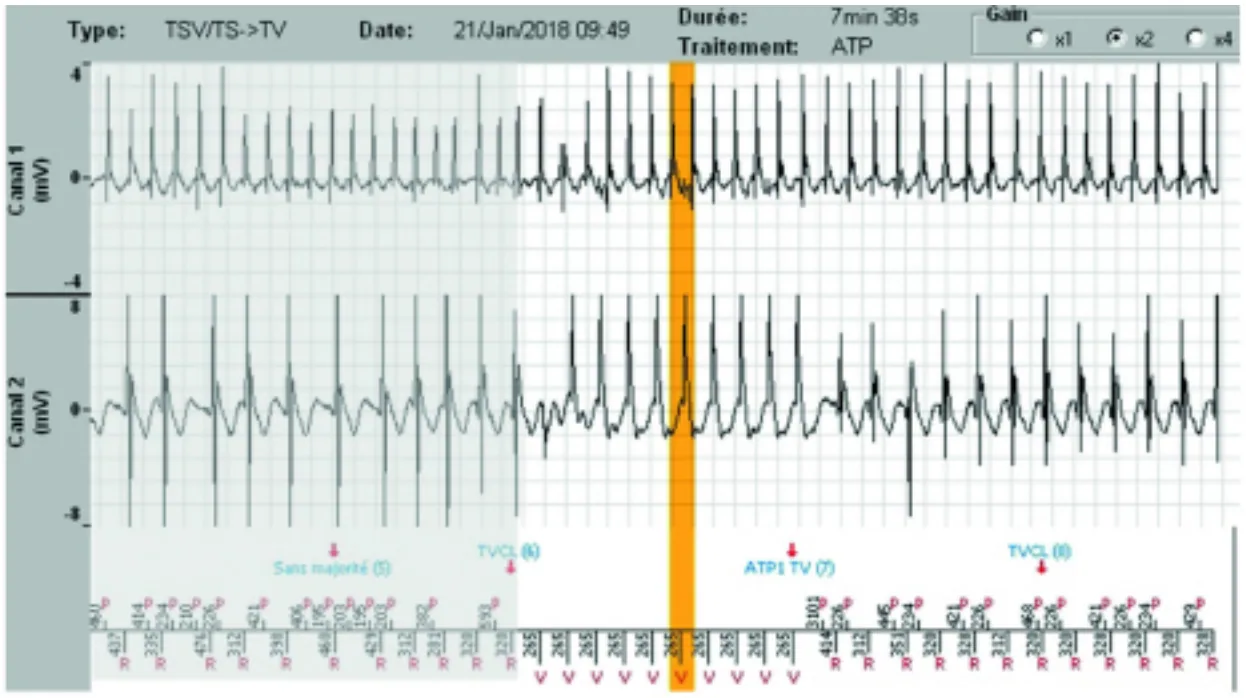 MicroPort DAI, EGM — Stabilisation d’une tachycardie sur fond d’arythmie auriculaire; un diagnostic très difficile à poser