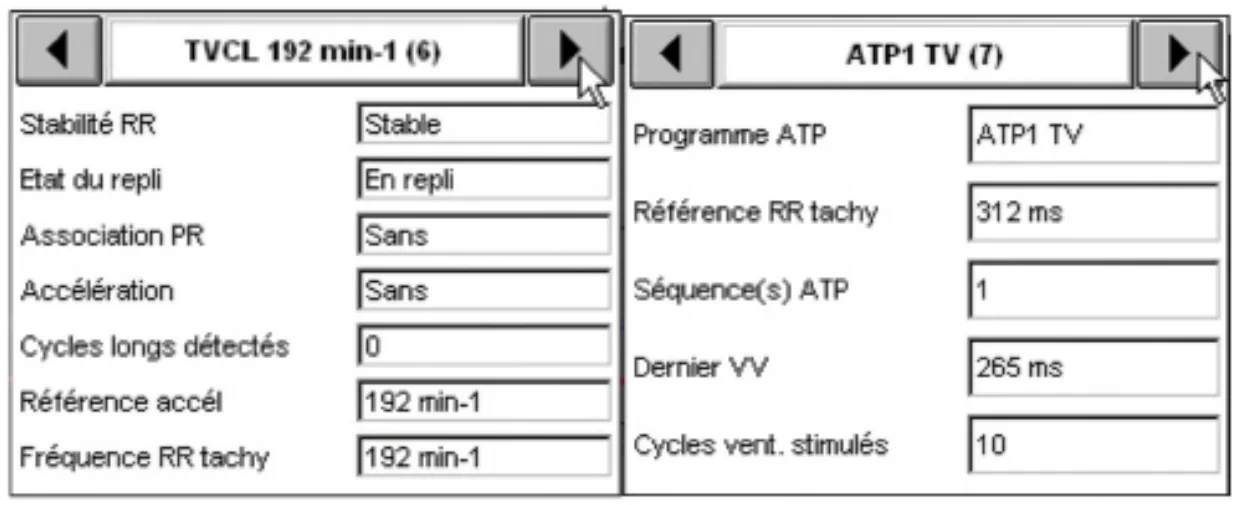 MicroPort DAI, Interprétation — Stabilisation d’une tachycardie sur fond d’arythmie auriculaire; un diagnostic très difficile à poser