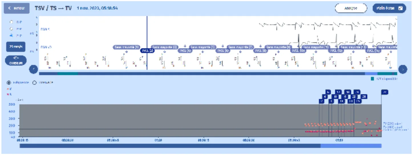 MicroPort DAI, EGM — Surdétection de l’onde T