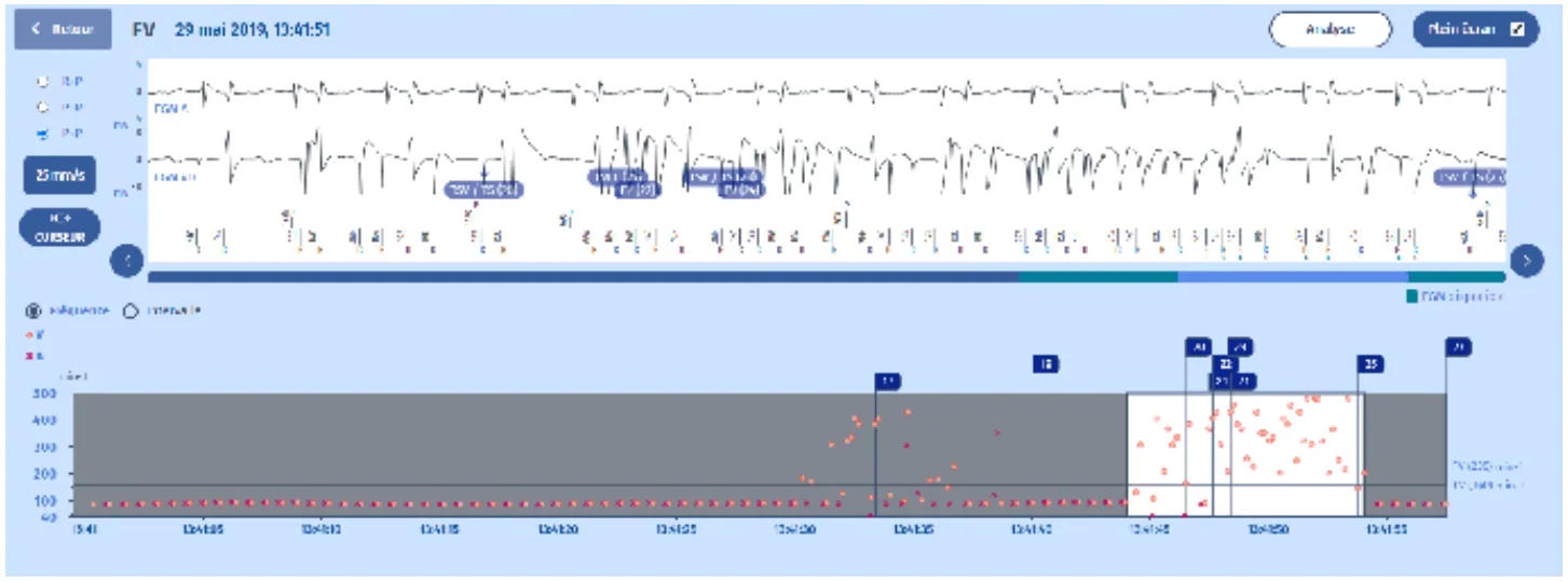 MicroPort DAI, EGM 2 (ancien tracé) — Dysfonction sonde