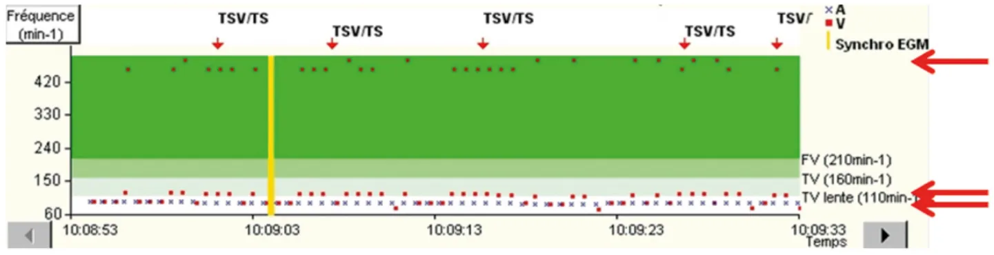 MicroPort DAI, Cas 4 — Surdétection des ondes P