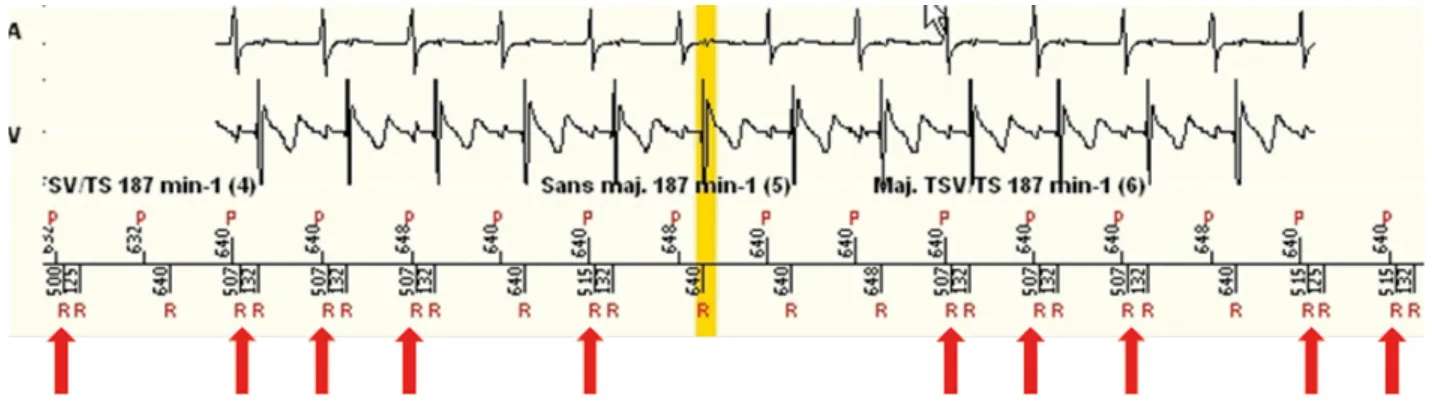 MicroPort DAI, Cas 4 — Surdétection des ondes P