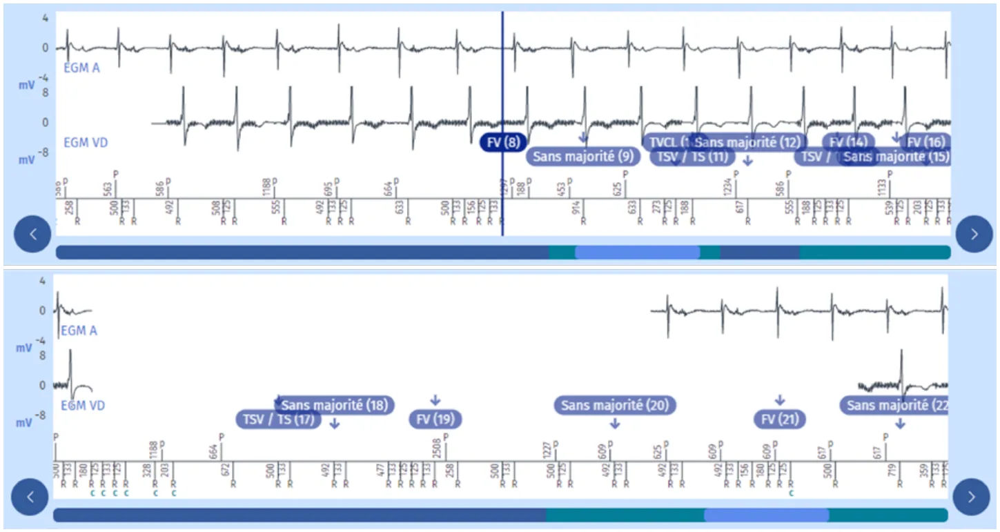 MicroPort DAI, Programmation — Une surdétection extracardiaque