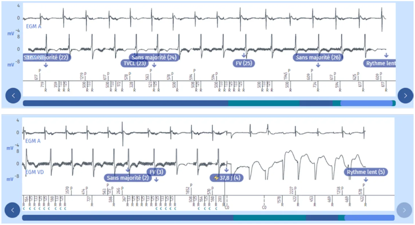 MicroPort DAI, Programmation — Une surdétection extracardiaque