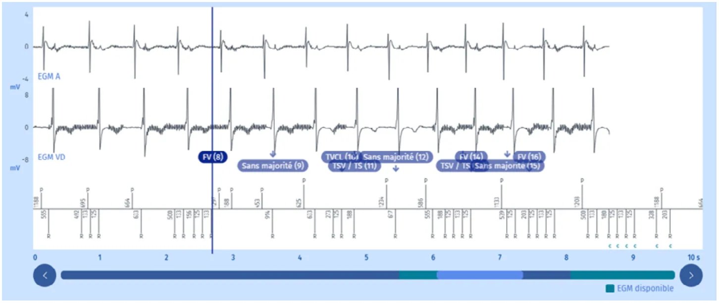 MicroPort DAI, Quel est votre diagnostic ? — Une surdétection extracardiaque