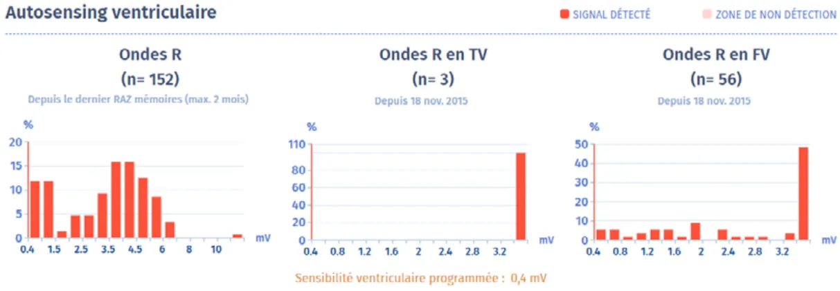 MicroPort DAI, Amplitudes des signaux ventriculaires — Une urgence !