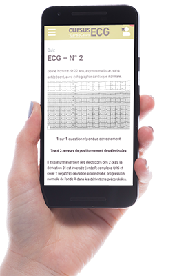 ECG