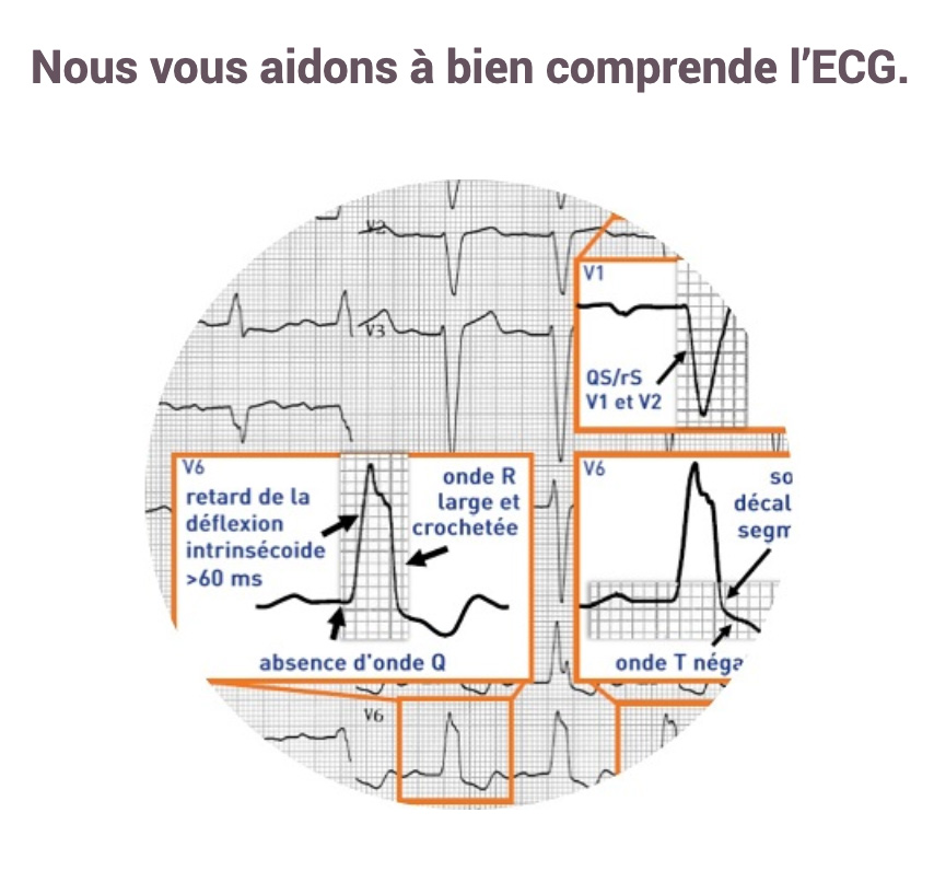 ECG