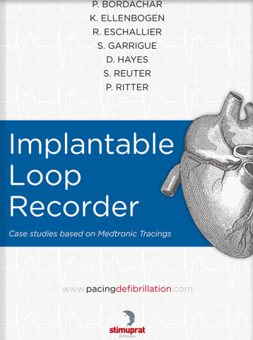 Medtronic Implantable Loop Recorder