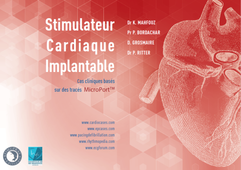 Stimulateur Automatique Implantable basé sur les tracés Microport