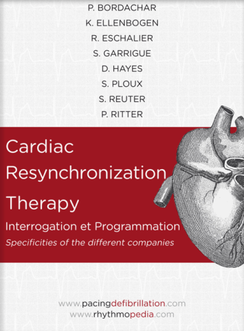 S.E.D.D. Cardiac Resynchronization Therapy