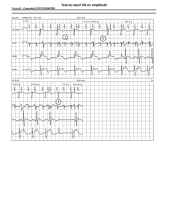 Seuil VG sur sonde unipolaire