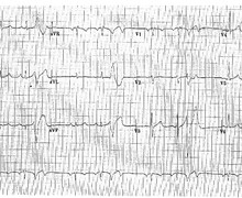 ESV très précoce et risque de fibrillation ventriculaire