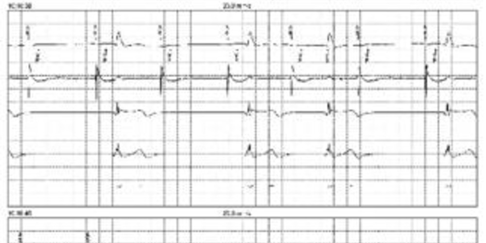 ventricular paced failure to capture