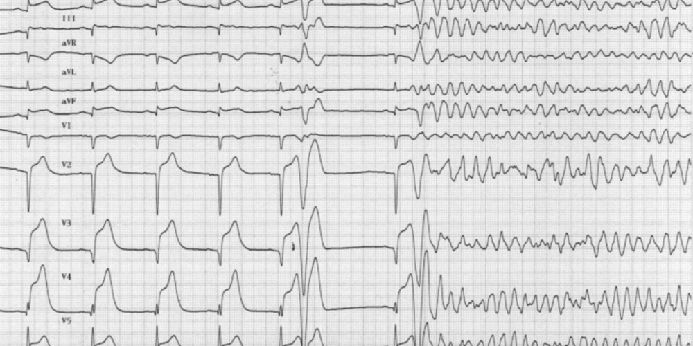 Fibrillation ventriculaire symptomes