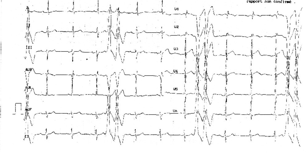 Doublets ventriculaires et dysplasie arythmogène du ventricule droit (ECN)