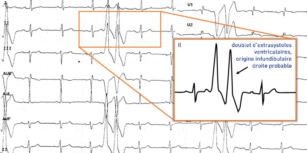 Doublets ventriculaires et dysplasie arythmogène du ventricule droit (ECN)