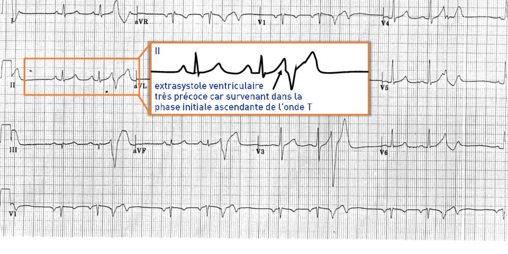 Extrasystole ventriculaire