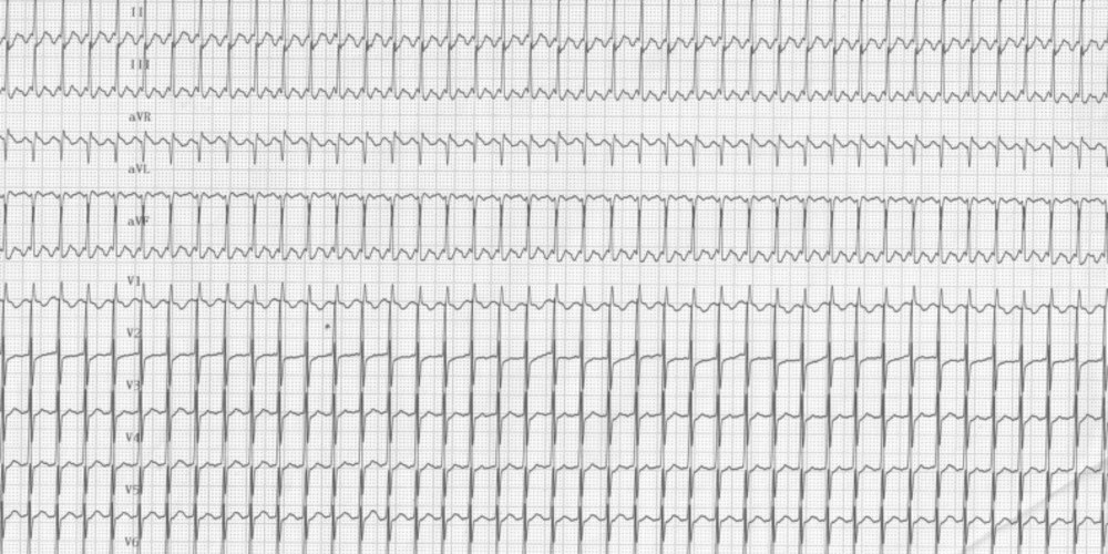 cpt code for ablation of typical atrial flutter