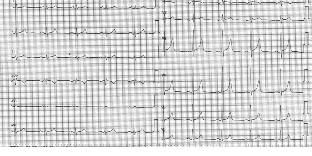 Mitral Regurgitation Cardiocases - 