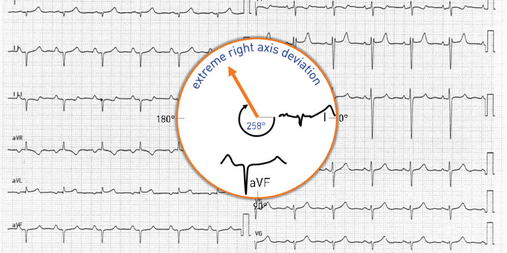 Chronic cor pulmonale  Cardiocases