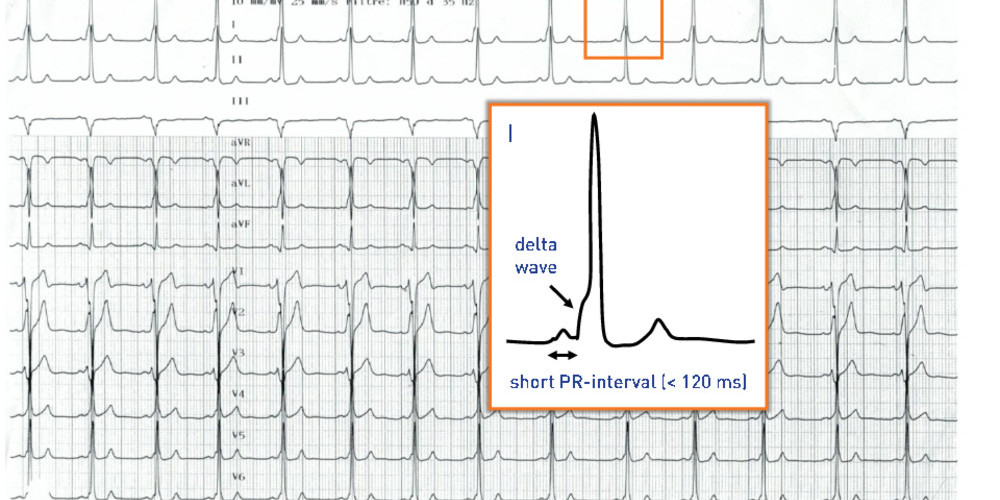 Short Pr Interval And Ventricular Pre Excitation Cardiocases