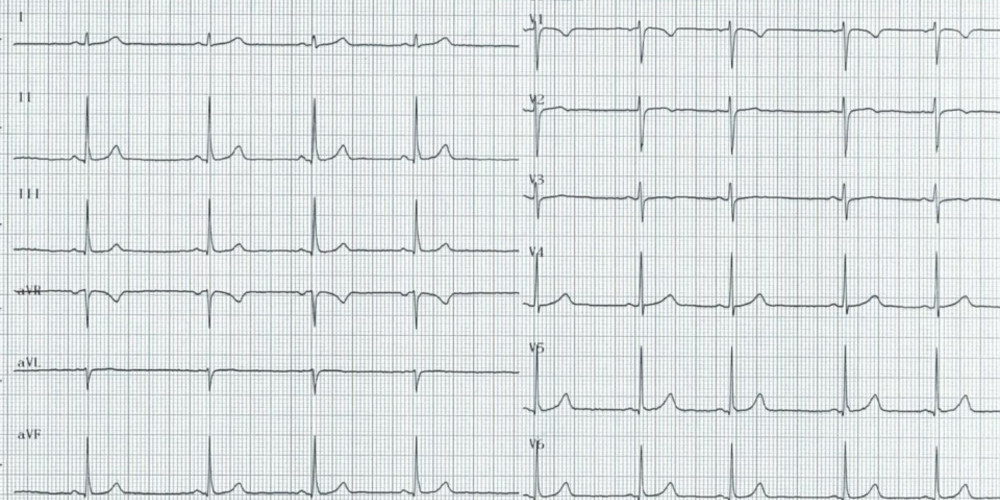 Normal Pr Interval Cardiocases