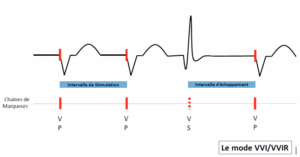 Normal Vvi Pacemaker Mode Pacemaker Pacing Modes: VVI, DDD, AAI, DDDR Explained | Cardiocases